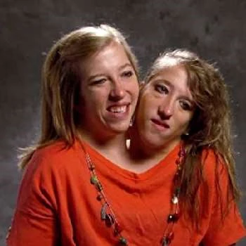 Abby Hensel - Wiki, Family, Bio, Birthdate, Networth & More