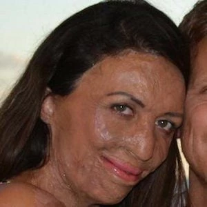Turia Pitt - Age, WIki, Birthday, Family, Networth & More